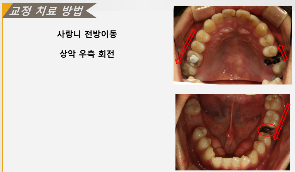 사랑니 전방이동을 계획한 위아래 치열 사진. 빨간 화살표가 계획한 이동 방향을 보여준다.
