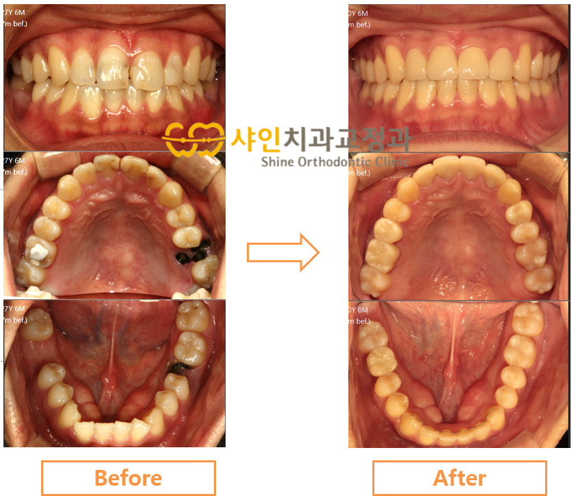 동일 환자의 치료 전후 비교. 왼쪽은 2020년 5월 치료 전, 오른쪽은 2023년 5월 결과 사진이며 정면과 위아래 치열을 나란히 보여준다.