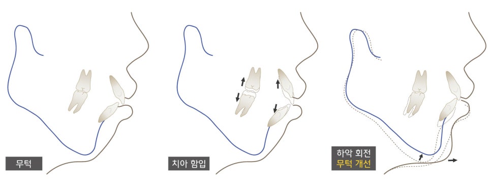어금니 함입에 따른 아래턱 회전 원리를 그린 원문 도식
