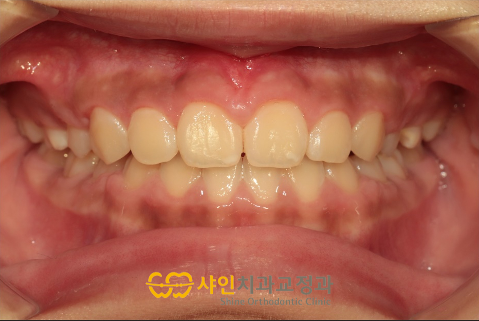 2024년 10월 4일, 치료 후 앞니의 맞물림을 보여주는 정면 구강 사진