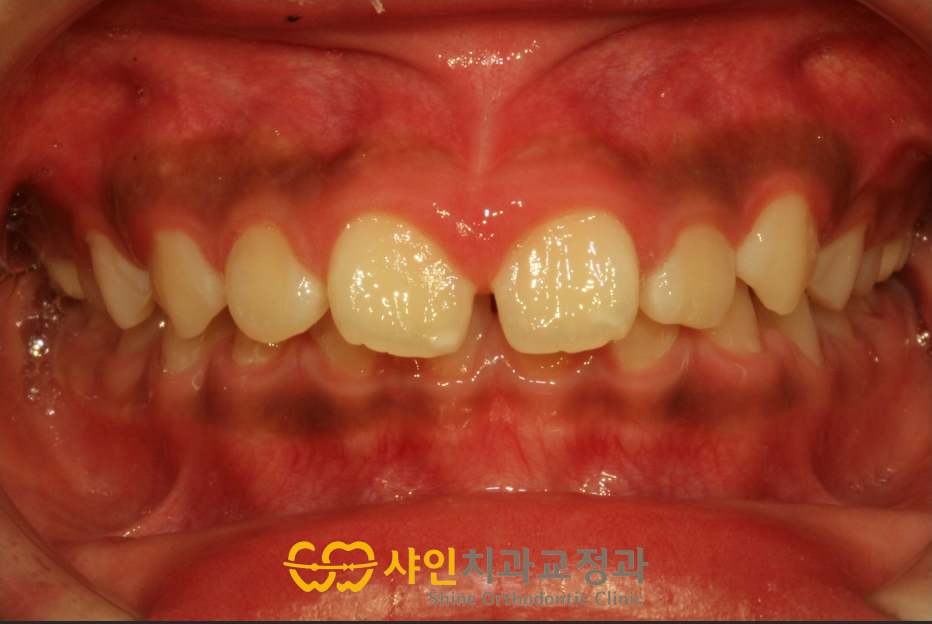 2023년 1월 28일, 윗니가 아랫니를 깊게 덮는 치료 전 정면 구강 사진