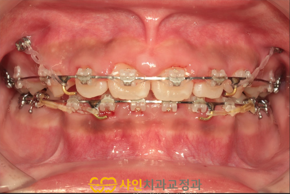2023년 8월 19일, 브라켓 치료 중인 정면 구강 사진
